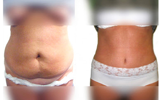 Abdominoplasty (Tummy Tuck) before and after image