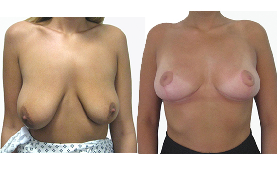 before and after gallery photos of breast asymetry operation by mr hassan shaaban cosmetic surgeon