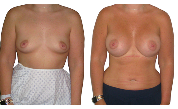 Before and after photo of breast enlargement performed by Mr Hassan Shaaban
