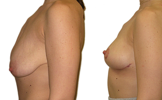 images of before and after breast uplift surgery - surgery by Mr Hassan Shaaban