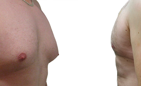 photos of male breast reduction before and after surgery.