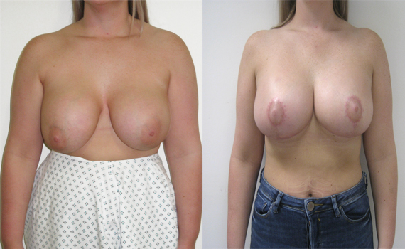 before and after photographs of breast uplift surgery