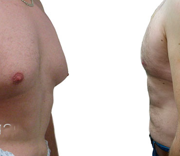 male breast reduction image showing before and after results of a gynaecomastia