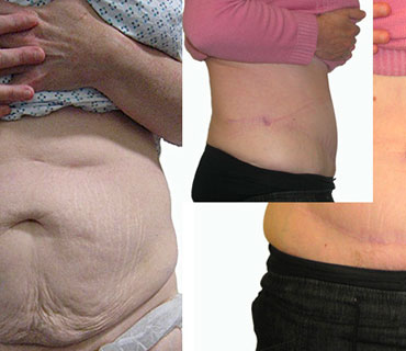 tummy tuck surgery or abdominoplasty before and after surgery