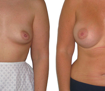 breast enlargement sometimes refered to as a boob shop before and after images performed by mr hassan shaaban consultant plastic surgeon