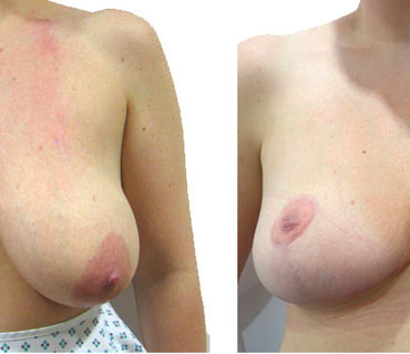 before and after images of a breast reduction performed by consultant surgeon mr hassan shaaban