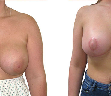 A breast uplift (or breast lift/mastopexy) performed by mr hassan shaaban images show before and after surgery