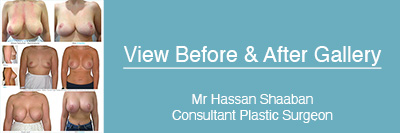 Plastic Surgery Before and After Photos performed by Hassan Shaaban consultant plastic surgeon