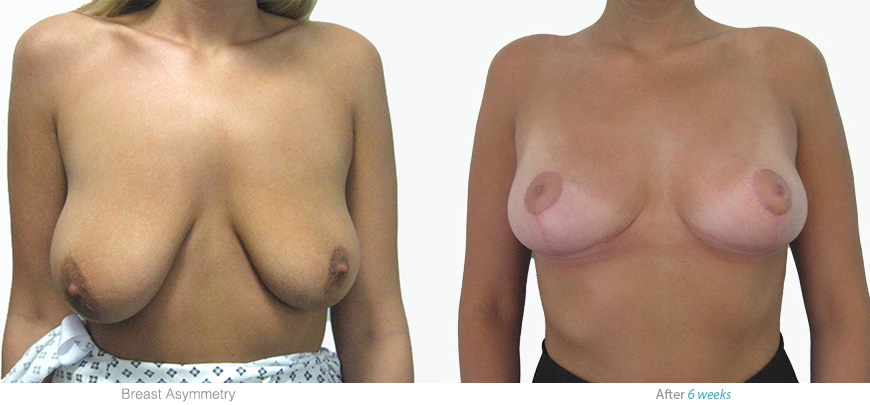 before and after surgry to correct breast asymmetry