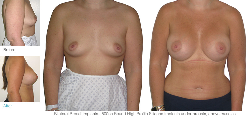 breast enlargements performed by one of the best breast enlargement surgeons Mr Hassan Shaaban