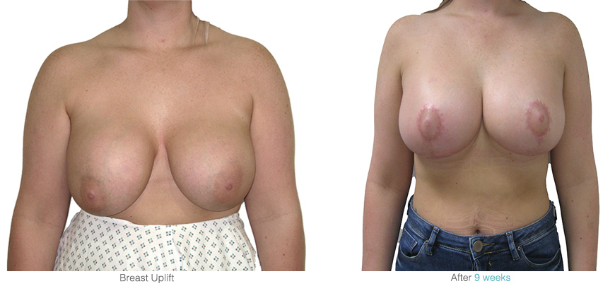 Breast uplifts performed by elite breast surgeon Mr Hassan Shaaban at Aset Hospital
